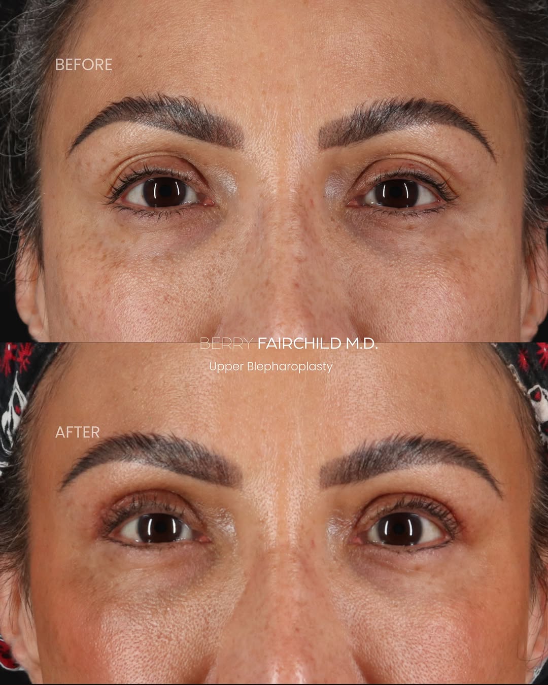 Instagram post by Dr. Berry Fairchild: 3 months postop after upper blepharoplasty + CO₂ Helix ✨ Sometimes a little refresh is all you need. She already had beautiful skin, but wan…