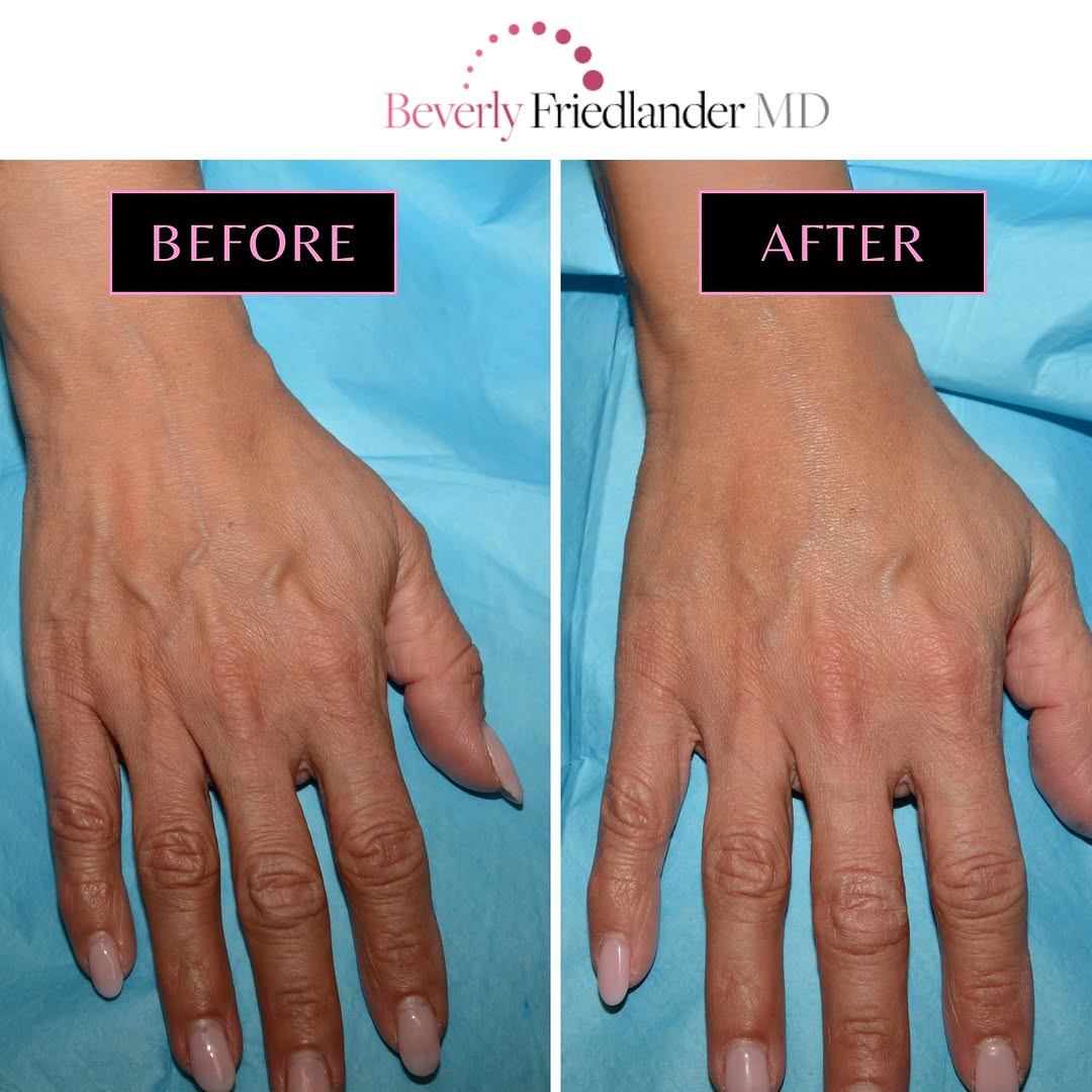 Instagram post by Dr. Beverly Friedlander: Hands are often one of the first areas to show signs of aging. Over time, volume loss can make veins, tendons, and texture more noticeable. …