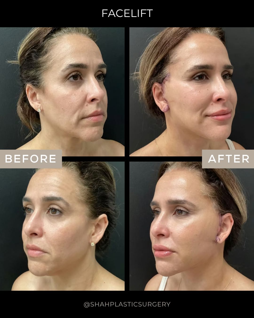 Instagram post by Dr. Bharat Shah: Before and after, a refreshed look that still looks like them. This 48-year-old patient is shown 1 week after surgery following a facelift w…
