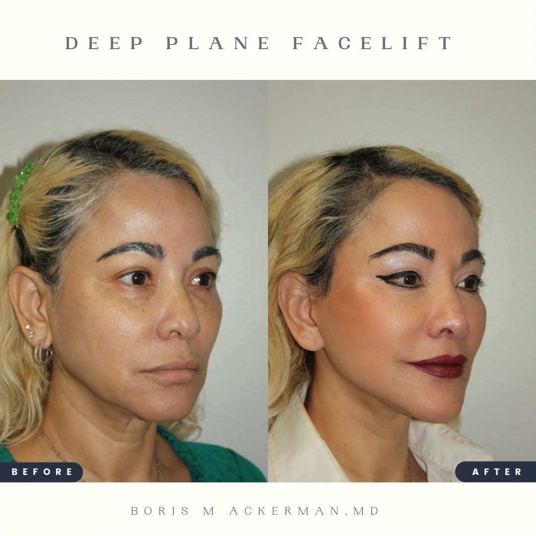 Instagram post by Dr. Boris M. Ackerman: The most natural-looking facial rejuvenation starts beneath the surface. A Deep Plane Facelift addresses the deeper structural changes of fa…