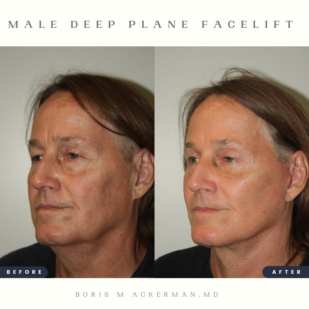 Instagram post by Dr. Boris M. Ackerman: For men, the goal is not simply to look younger. It is to restore youthful definition while preserving masculine features and maintaining a …