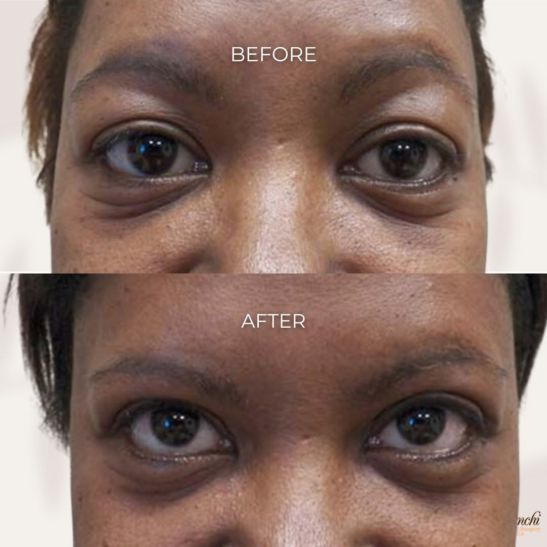 Instagram post by Dr. Bose Yalamanchi: ✨ Bright-Eyed & Refreshed – Blepharoplasty Transformation ✨ Tired, heavy eyelids can make you look older and even impact your desired facial…