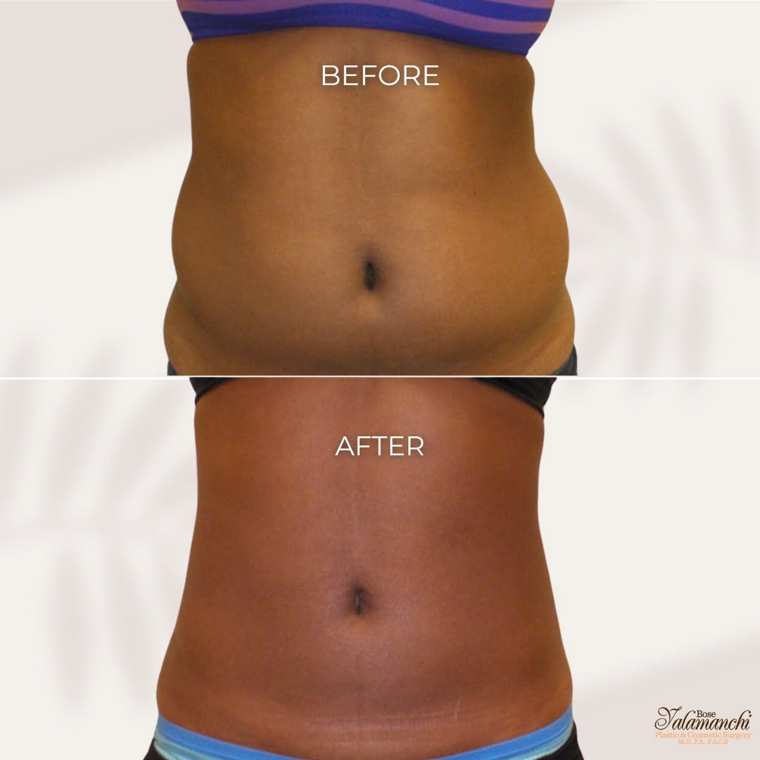 Instagram post by Dr. Bose Yalamanchi: Snatched, sculpted, and confidence-boosted!✨ Check out this incredible tummy tuck transformation by Dr. Yalamanchi—where expert technique me…