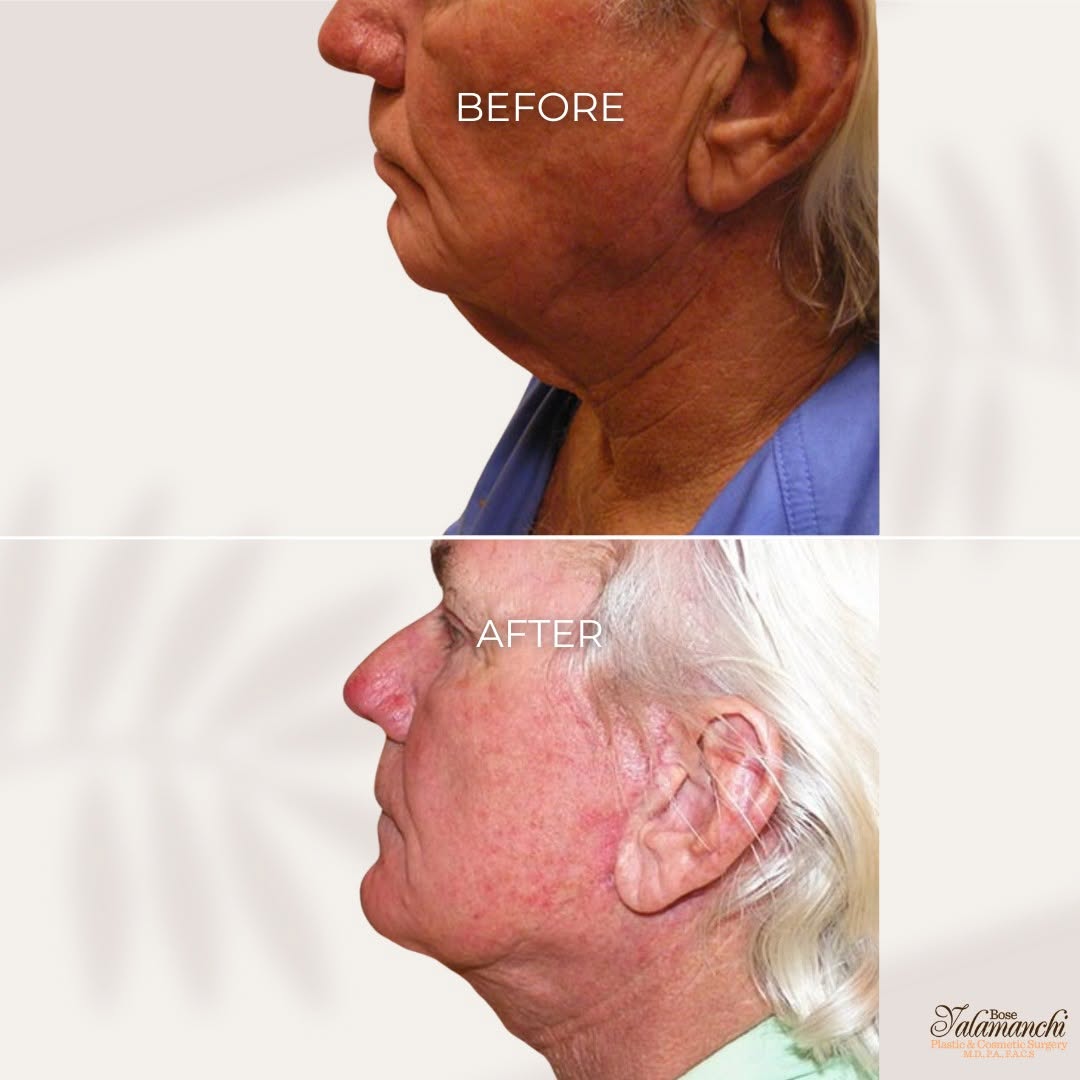 Instagram post by Dr. Bose Yalamanchi: Lifted. Sculpted. Renewed. ✨ Check out this beautiful neck lift transformation by Dr. Yalamanchi! A neck lift procedure not only tightens lo…