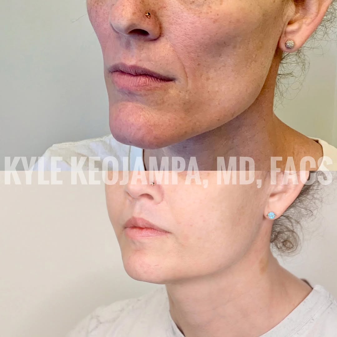 Instagram post by Dr. Bounmany Kyle Keojampa: To feminize a face and create a more youthful appearance, it’s essential to understand the differences in facial thirds and volume distribut…