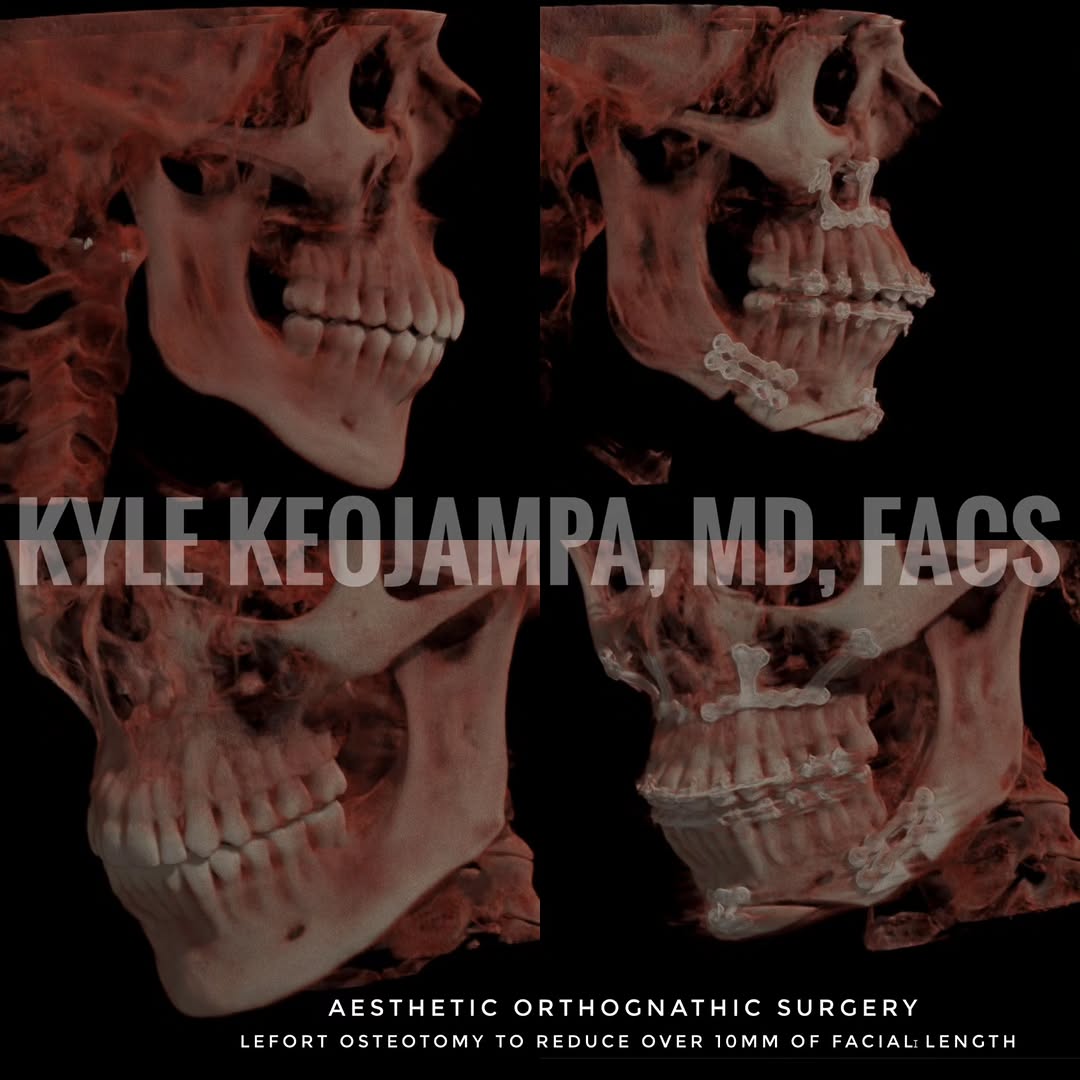 Instagram post by Dr. Bounmany Kyle Keojampa: A common procedure we perform is Aesthetic Orthognathic surgery to reduce facial length and improve facial harmony. This can immensely chang…