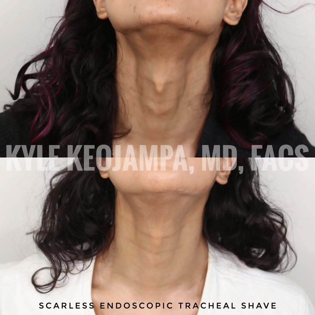 Instagram post by Dr. Bounmany Kyle Keojampa: We are a world leader in scarless endoscopic tracheal shave and no visible incision endoscopic facelifts. For patients prone to unfavorable …