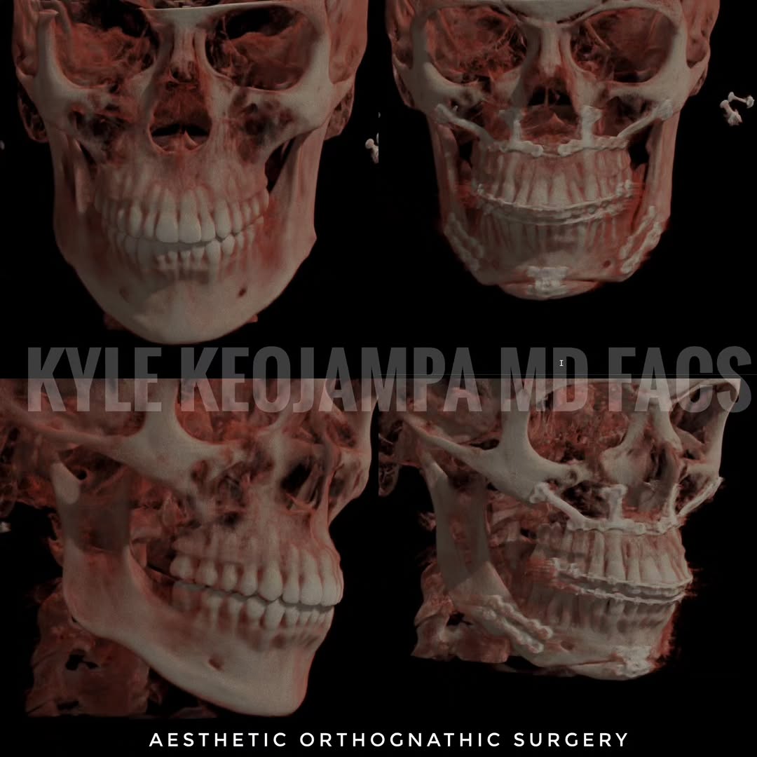 Instagram post by Dr. Bounmany Kyle Keojampa: Aesthetic Orthognathic and Double Jaw Surgery. Drop your questions about surgery and we will answer them!