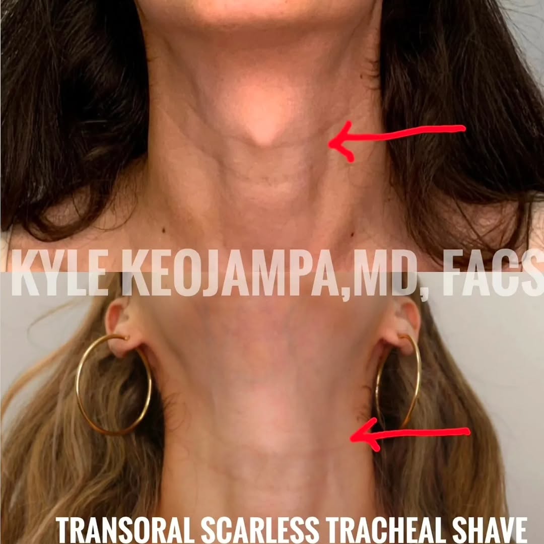 Instagram post by Dr. Bounmany Kyle Keojampa: How did we develop our scarless tracheal shave technique in 2018? Read about it here https://medium.com/@kyle_keojampa/the-pursuit-of-invisi…