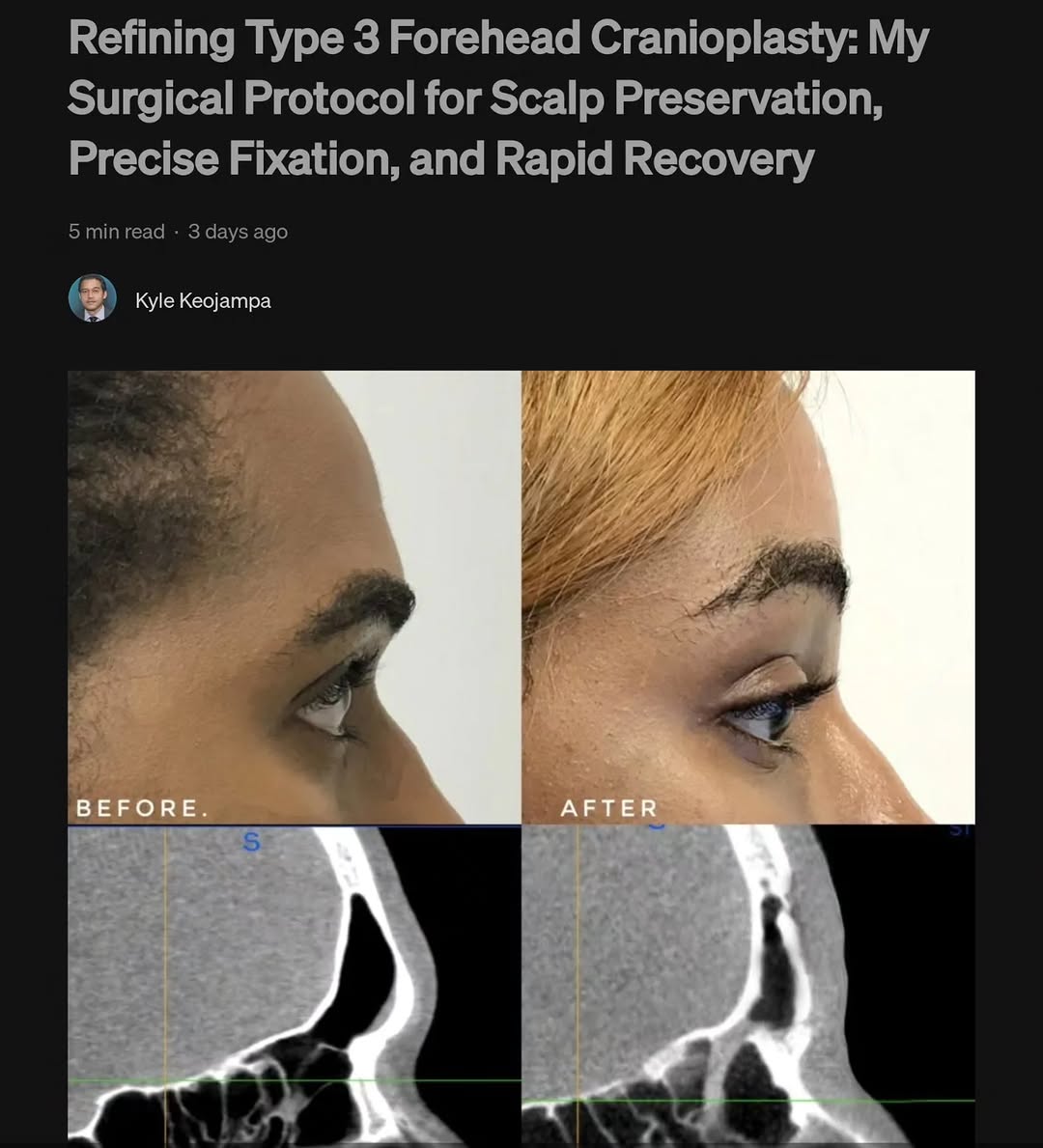Instagram post by Dr. Bounmany Kyle Keojampa: For surgeons and prospective patients, I wrote an article detailing my exact technique for Forehead cranioplasty with no drains, no metal ha…