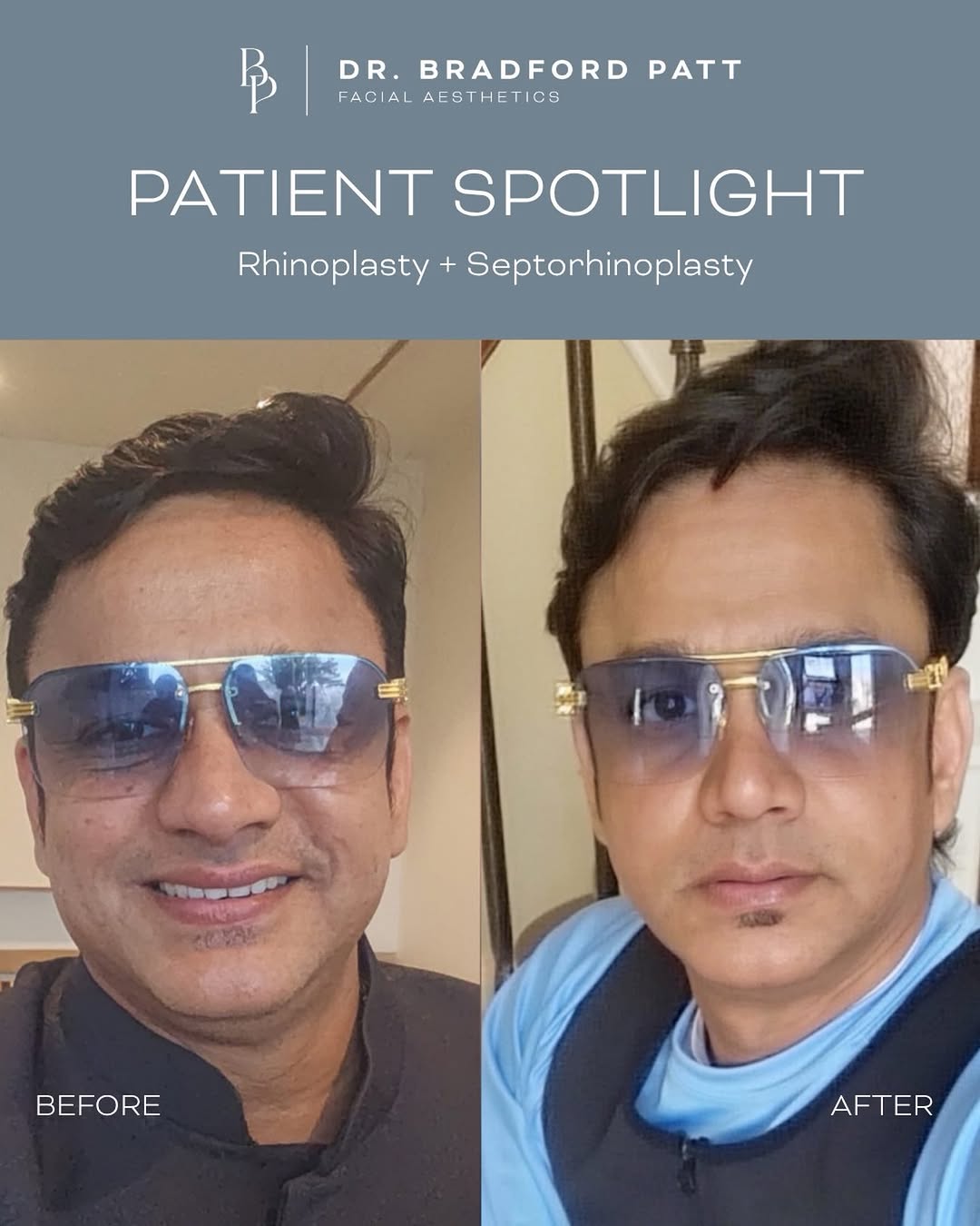 Instagram post by Dr. Bradford S. Patt: A more defined tip, while still looking completely natural. 👃 This patient shared a selfie from before and after his rhinoplasty + septopla…