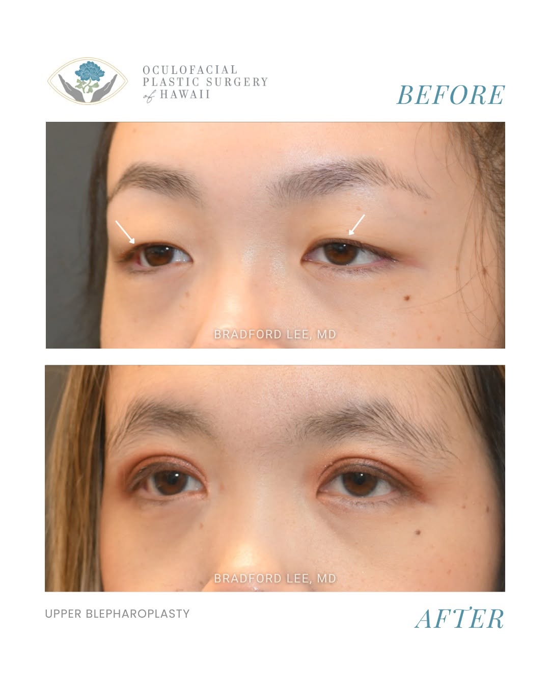 Instagram post by Dr. Bradford W. Lee: This patient was bothered by the appearance of a monolid (single eyelid) and underwent an upper blepharoplasty to achieve a natural-looking …