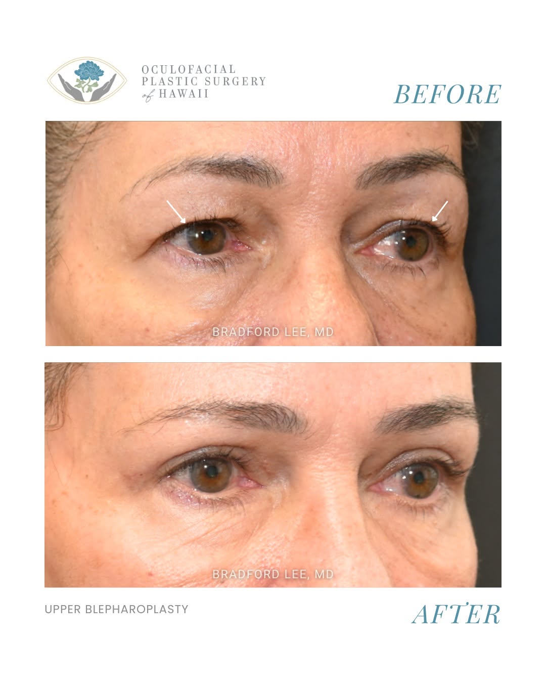 Instagram post by Dr. Bradford W. Lee: This patient was bothered by excess skin on both upper eyelids that gave her eyes a heavier appearance. She underwent an upper eyelid blepha…