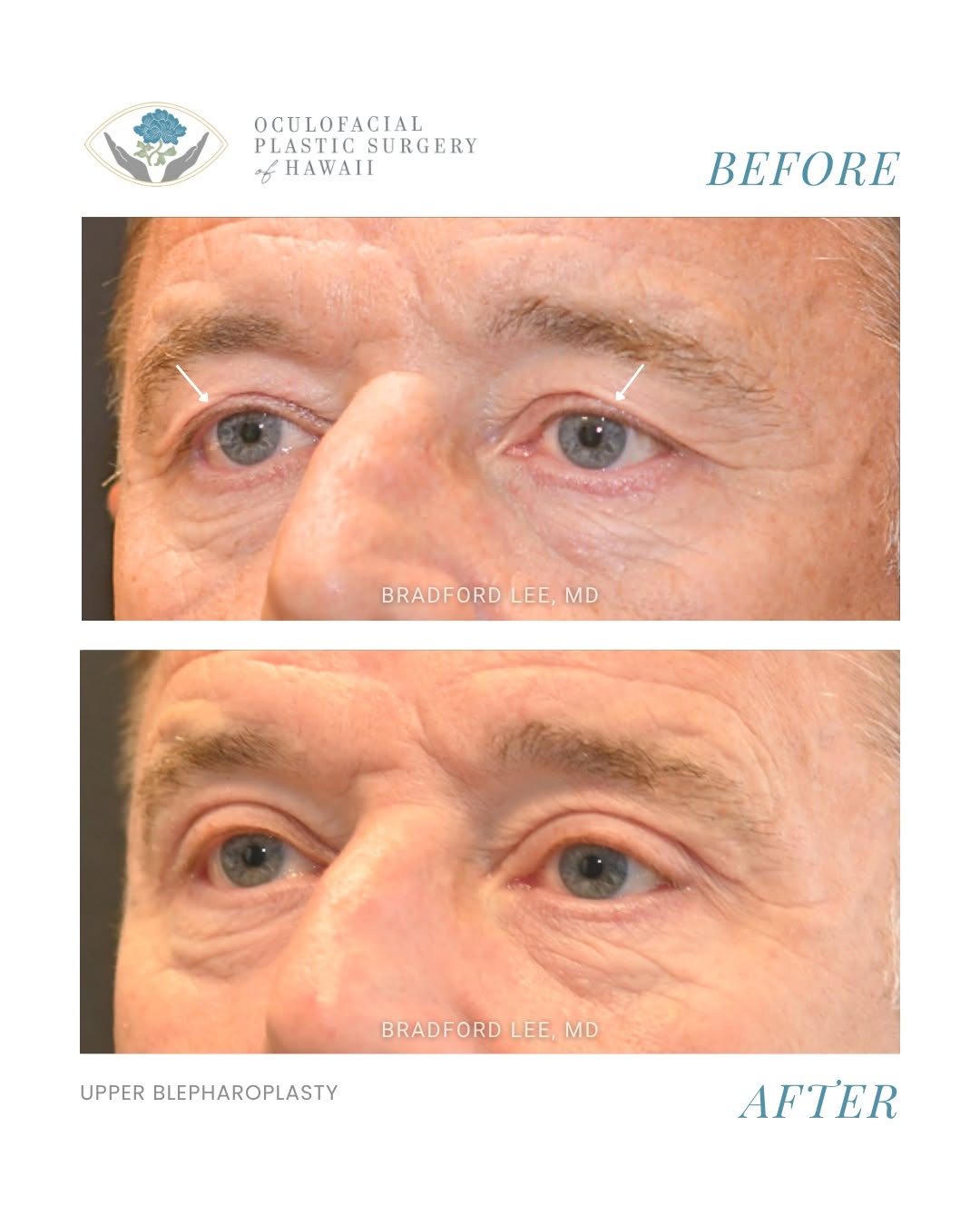 Instagram post by Dr. Bradford W. Lee: This patient was bothered by excess skin and fat on both upper eyelids that affected the appearance of his eyes. He underwent an upper eyeli…