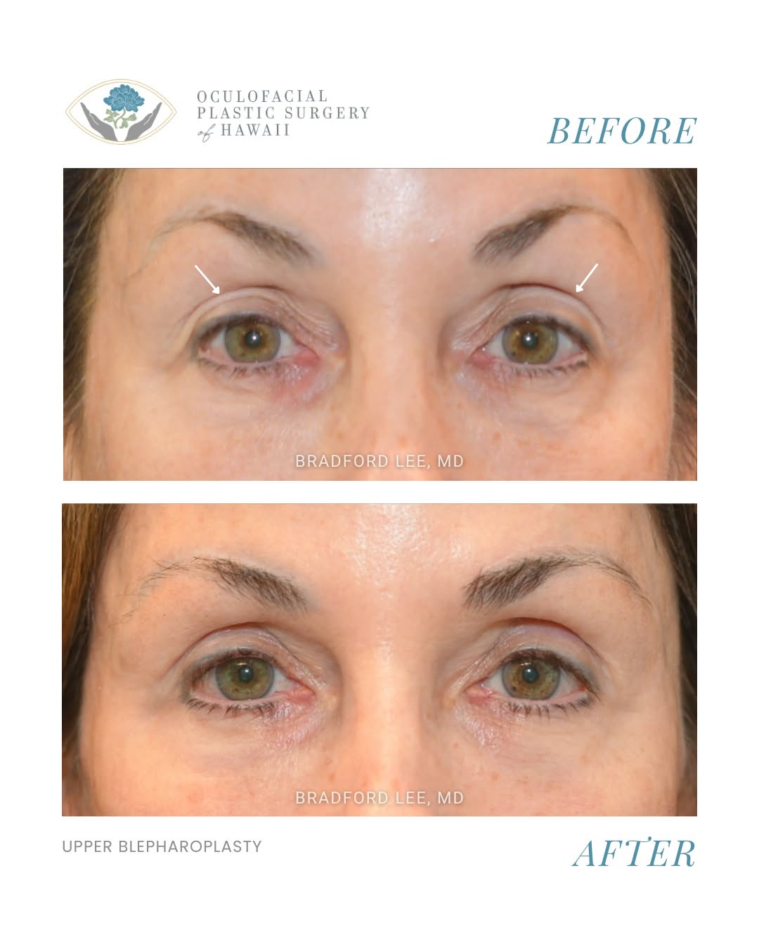 Instagram post by Dr. Bradford W. Lee: This patient was bothered by excess skin and hollowing of the upper eyelids, which contributed to a tired appearance. She underwent upper ey…