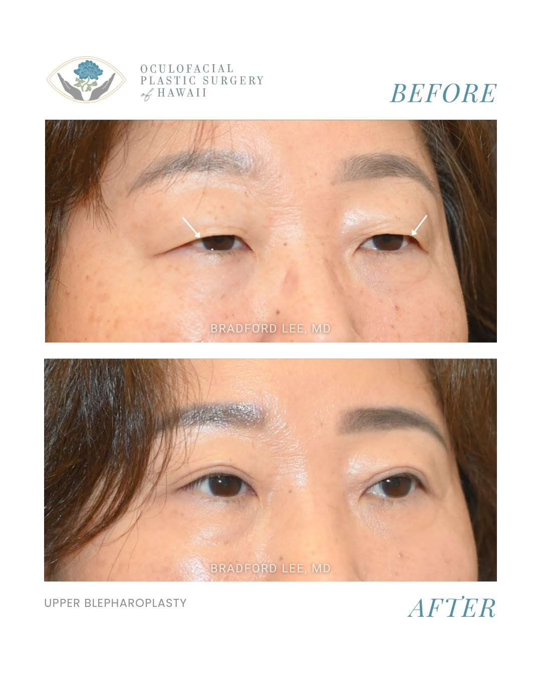 Instagram post by Dr. Bradford W. Lee: This patient was bothered by heavy upper eyelids that affected her vision and made everyday activities such as reading and driving more diff…