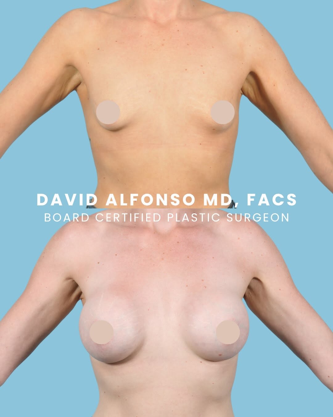 Instagram post by Dr. Bradley Bengtson: A little more fullness. A beautifully balanced shape. A result designed around her goals. ✨ This patient came to Dr. David Alfonso through a…