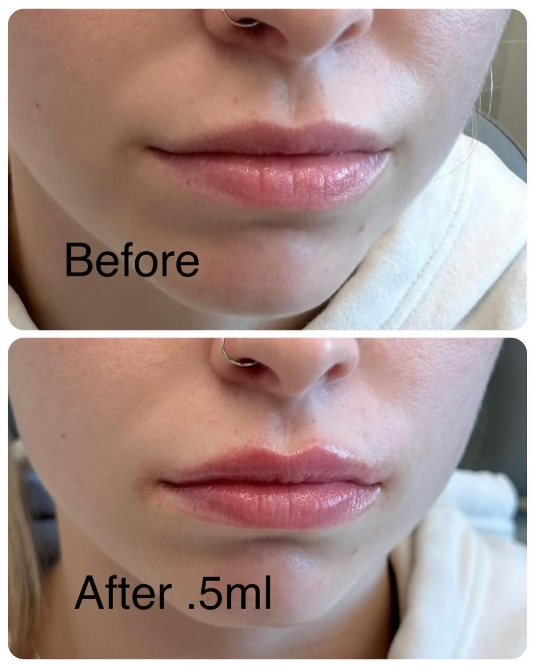 Instagram post by Dr. Brenda Schiesel, DO: Less is more! This stunning transformation was achieved with just half a syringe of lip filler — proof that a little goes a long way when it…