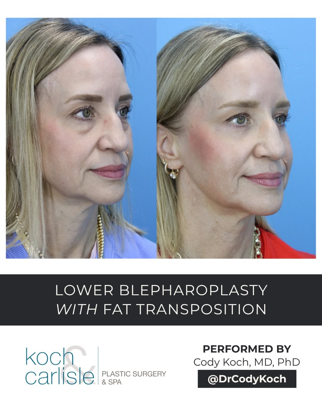 Instagram post by Dr. Brenton B. Koch: For this patient, I performed a lower blepharoplasty with fat transposition to address the fullness and hollowing beneath her eyes. These tw…