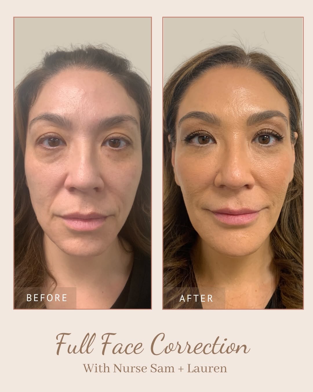 Instagram post by Dr. Brett E. Stompro: These photos were taken three months apart, showcasing the incredible transformation achieved by Nurse Sam and Nurse Lauren on their favorit…