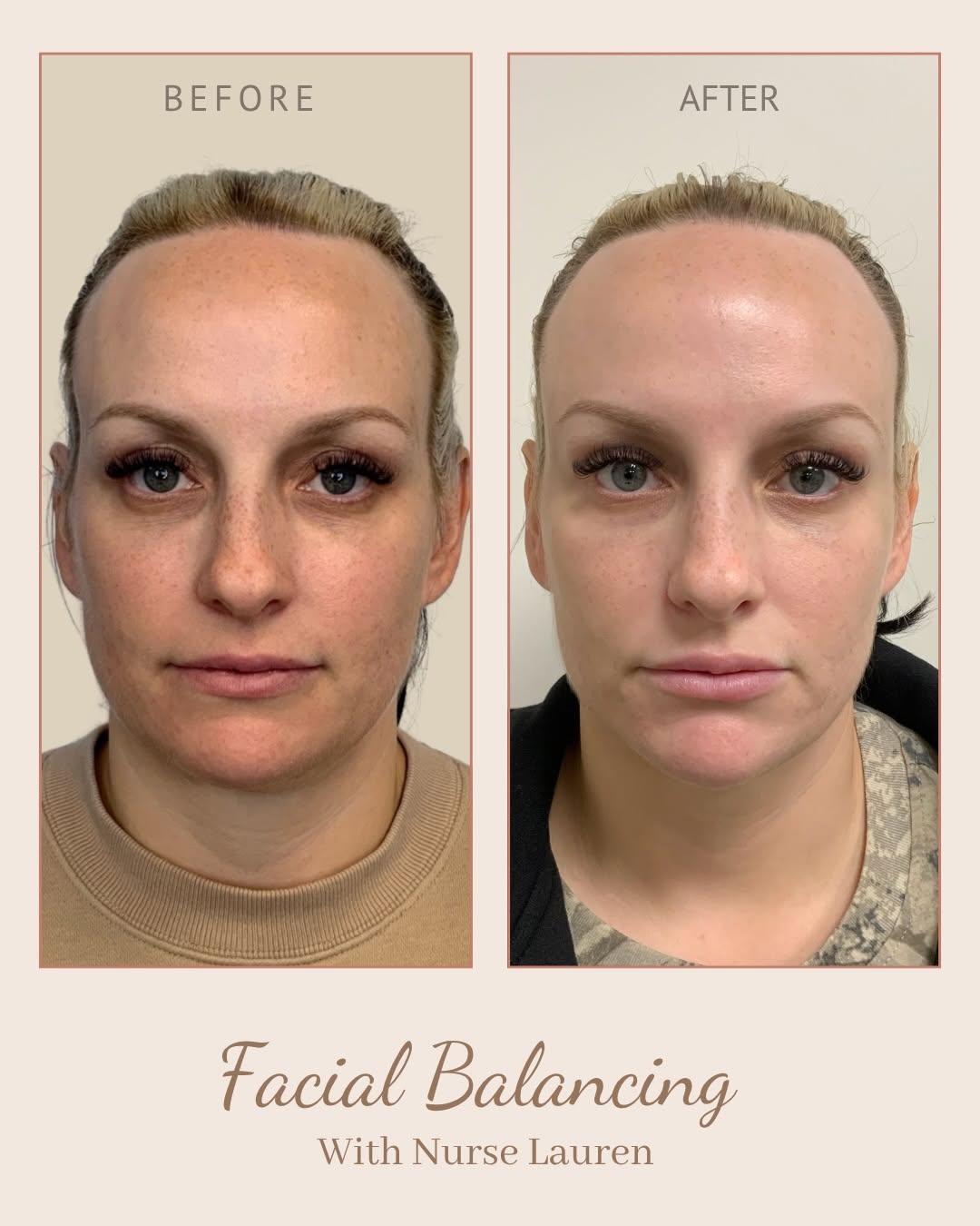 Instagram post by Dr. Brett E. Stompro: FACIAL BALANCING ✨ A comprehensive combination of Botox + filler designed to enhance facial proportions, soften unwanted lines, and create m…