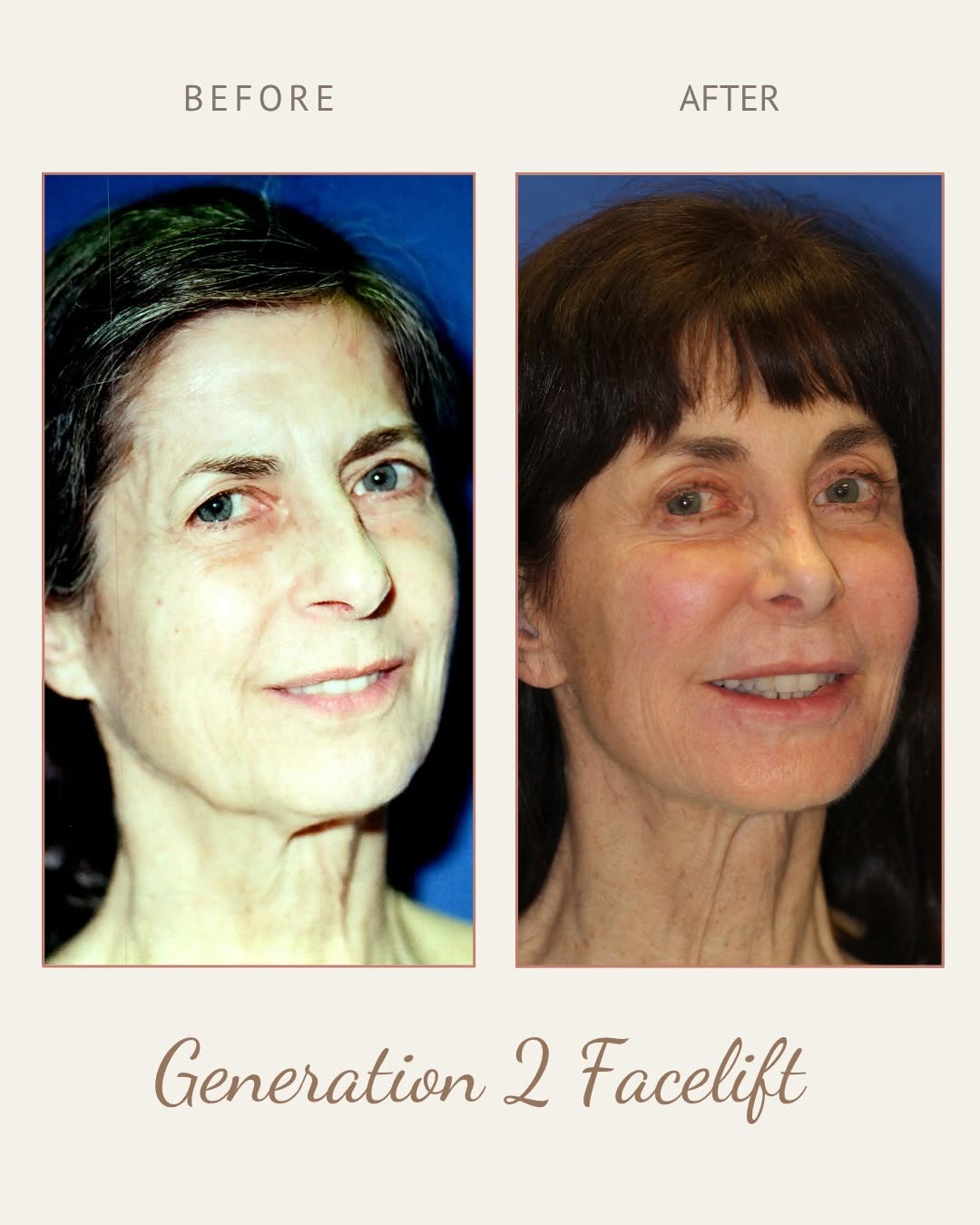 Instagram post by Dr. Brett E. Stompro: Generation 2 vs. Generation 3 facelift. Facelift surgery has evolved significantly over the years, and these examples show just how differen…