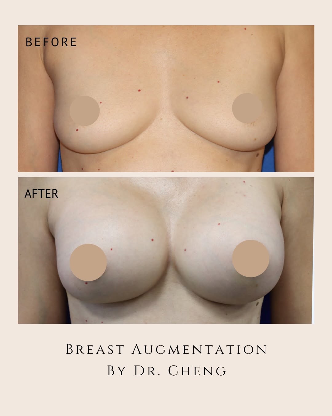 Instagram post by Dr. Brett E. Stompro: A beautiful breast augmentation transformation by Dr. Cheng 🤍 This before & after shows how thoughtful implant selection and surgical techn…