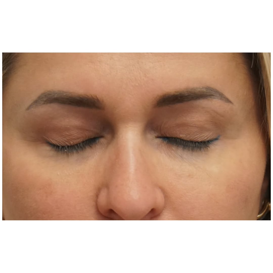 Instagram post by Dr. Brett S. Kotlus: Swipe for open-eyed result. Here's an incision example 3 months after upper blepharoplasty. Not everyone heals this quickly and this perfect…