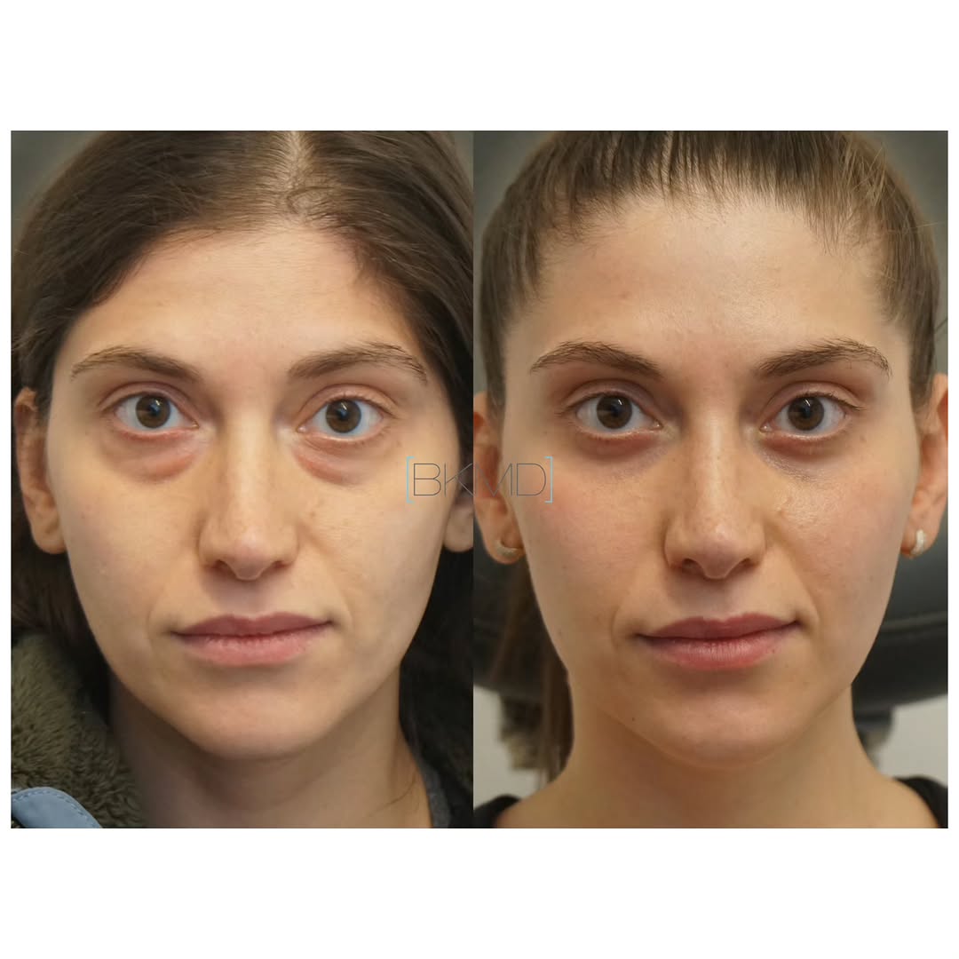 Instagram post by Dr. Brett S. Kotlus: #byebags #fatgrafting #blepharoplasty