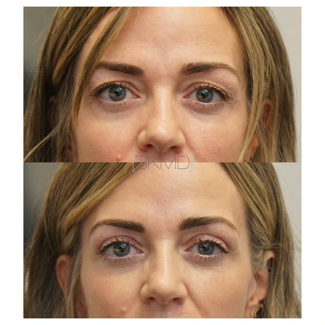 Instagram post by Dr. Brett S. Kotlus: #blepharoplasty #co2laser #eyelift