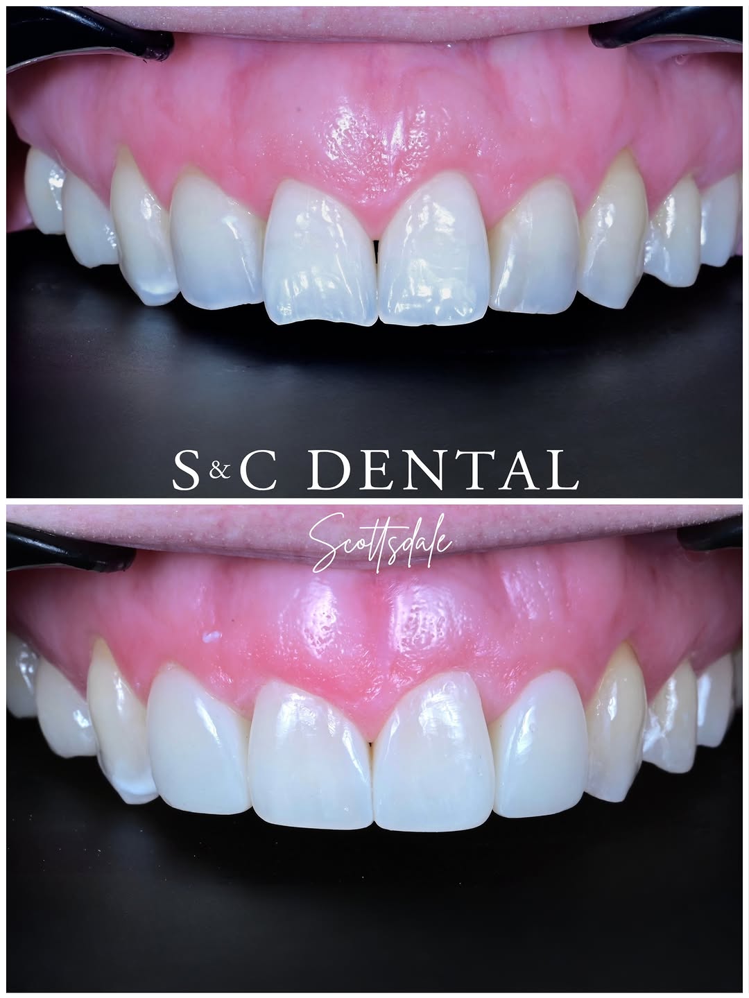 Instagram post by Dr. Bri Stoterau, D: Worth the drive from Vegas ✨ Patient came in with chipped edges, gaps, and uneven shapes that had been bothering them for a while. After a v…