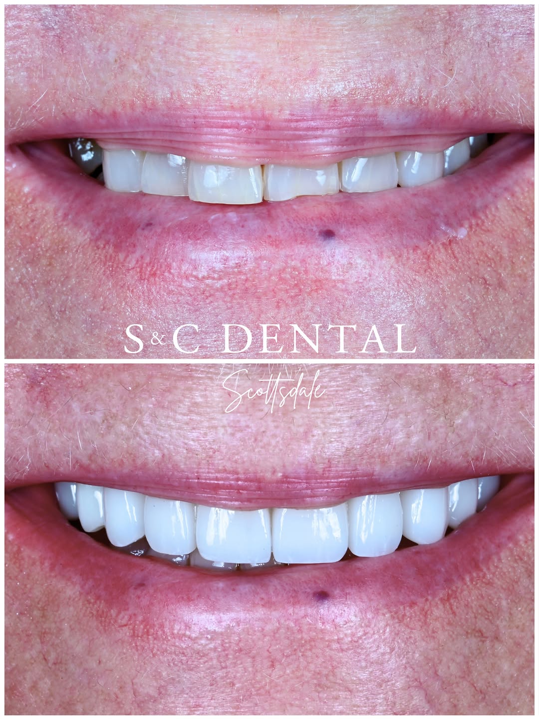 Instagram post by Dr. Bri Stoterau, D: This smile needed a fresh start ✨ Years of grinding had worn her teeth down and flattened her bite. Fourteen porcelain veneers rebuilt the l…