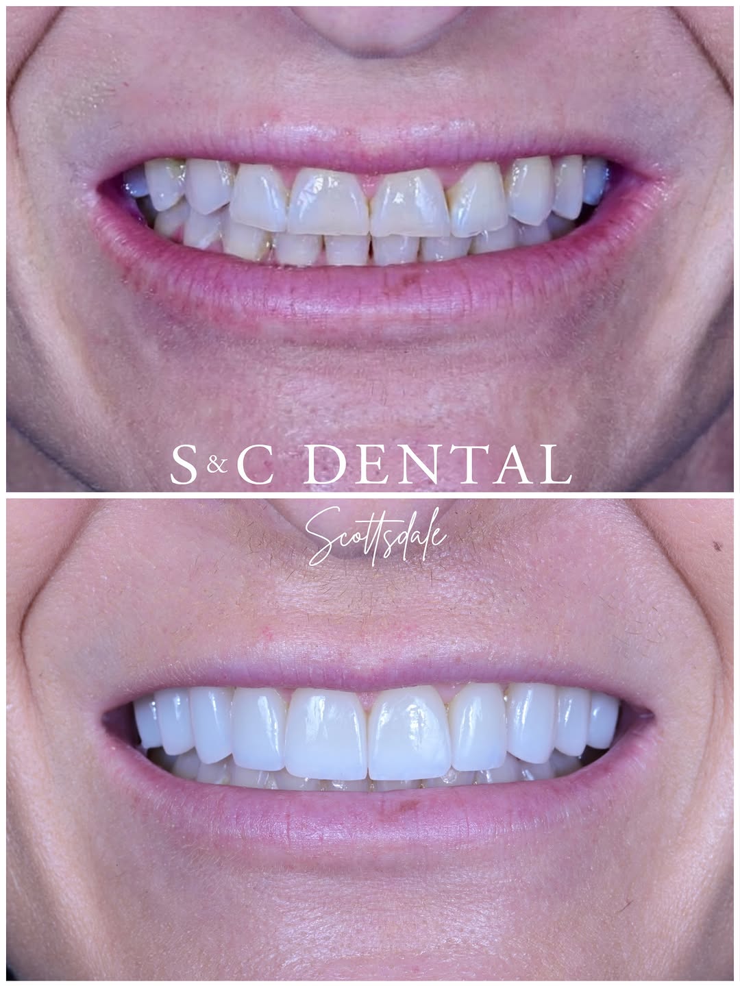 Instagram post by Dr. Bri Stoterau, D: 10 no-prep veneers, zero shaving down of the teeth ✨ This patient wanted to improve the shorter appearance and yellow color of her teeth whi…
