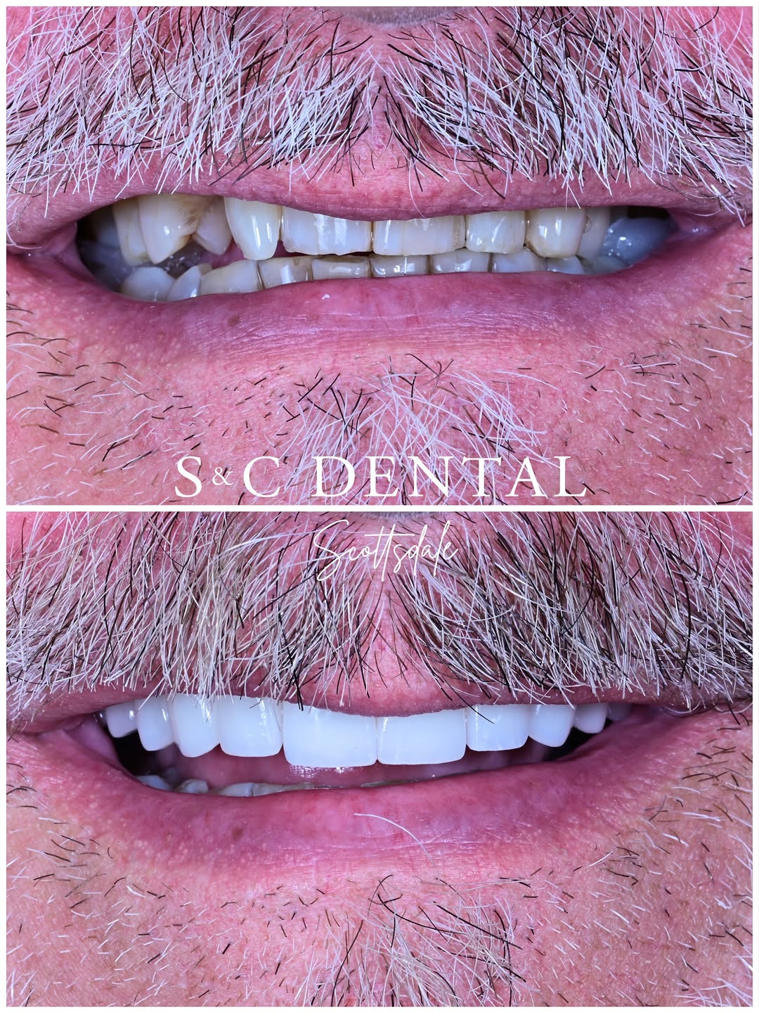 Instagram post by Dr. Bri Stoterau, D: 12 veneers on top and a whole new smile ✨ This patient wanted to address the color and the wear that had shortened his upper teeth over the …