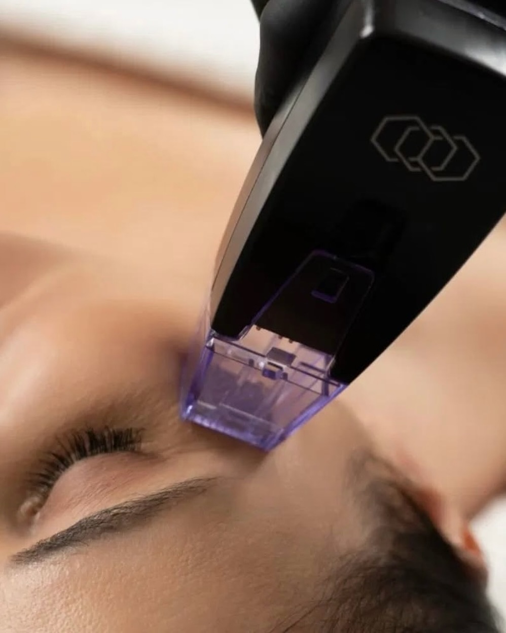 Instagram post by Dr. Brian J. Parker: Smoother texture, firmer skin, and a refreshed look without surgery. ✨ Morpheus8 combines microneedling with radiofrequency energy to stimul…