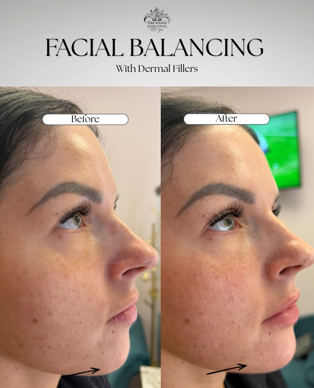 Instagram post by Dr. Brian Joseph: A small amount of filler can make a beautiful difference. It’s not about adding volume everywhere—it’s about precise placement in the right …
