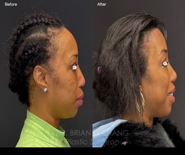 Instagram post by Dr. Brian L. Chang: One way we describe facial balance is with the facial thirds, where the hairline-brow, brow-nose, and nose-chin distances are proportional. …