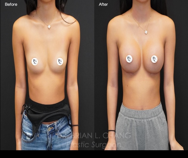 Instagram post by Dr. Brian L. Chang: ⭐️ Breast Augmentation ⭐️ This very fit patient came to me looking to feel more feminine and confident in fitted clothing. She had always be…
