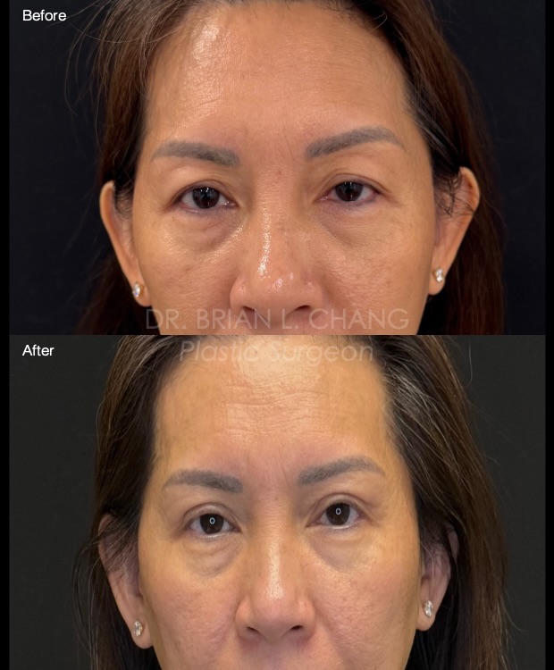 Instagram post by Dr. Brian L. Chang: ⭐️ Upper Blepharoplasty ⭐️ Upper eyelid surgery is my favorite aesthetic surgery to perform because of how much the eyes influence beauty, e…