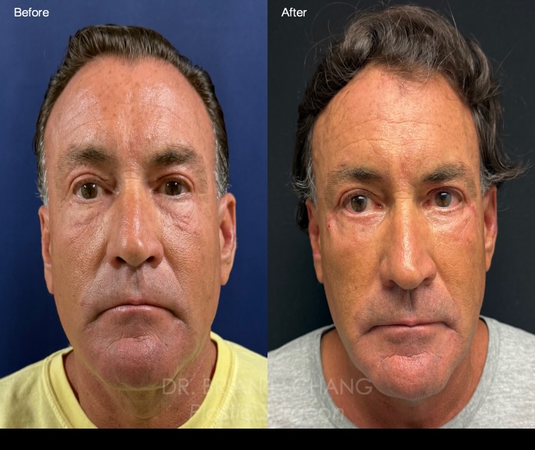 Instagram post by Dr. Brian L. Chang: ⭐️ Lower Blepharoplasty and Midface Lift ⭐️ This patient previously underwent 2 prior skin-only lower blepharoplasties, but was still bother…
