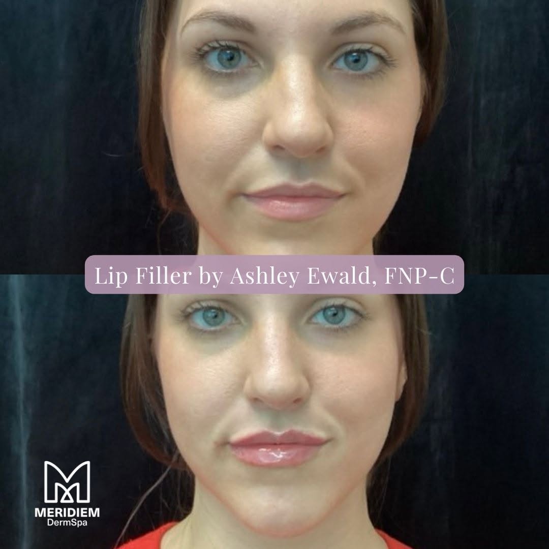 Instagram post by Dr. Brian L. Johnson: 💋 Customize your lip volume and enhance facial symmetry with lip filler results that emanate elegance and beauty. Let our expert injectors …