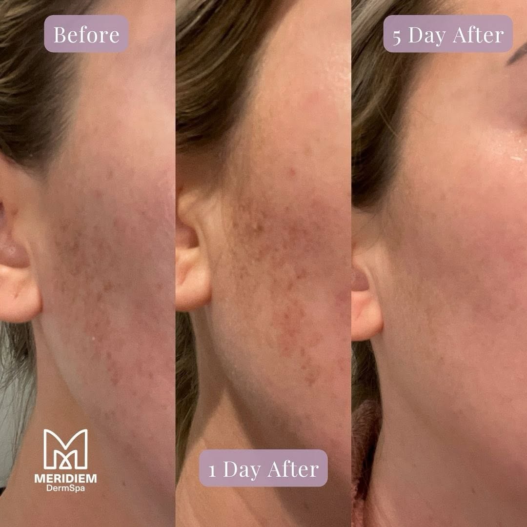 Instagram post by Dr. Brian L. Johnson: ☀️ BBL treatment specifically targets and diminishes sun spots, age spots, and other forms of hyperpigmentation, restoring your skin’s natur…