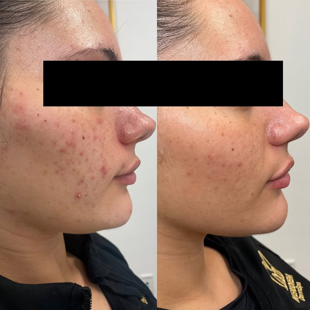 Instagram post by Dr. Brian L. Johnson: Look at this SKIN GLOW UP 🌟 With an effective yet simple medical grade skincare routine (listed below) + the VI Peel Purify with Precision …