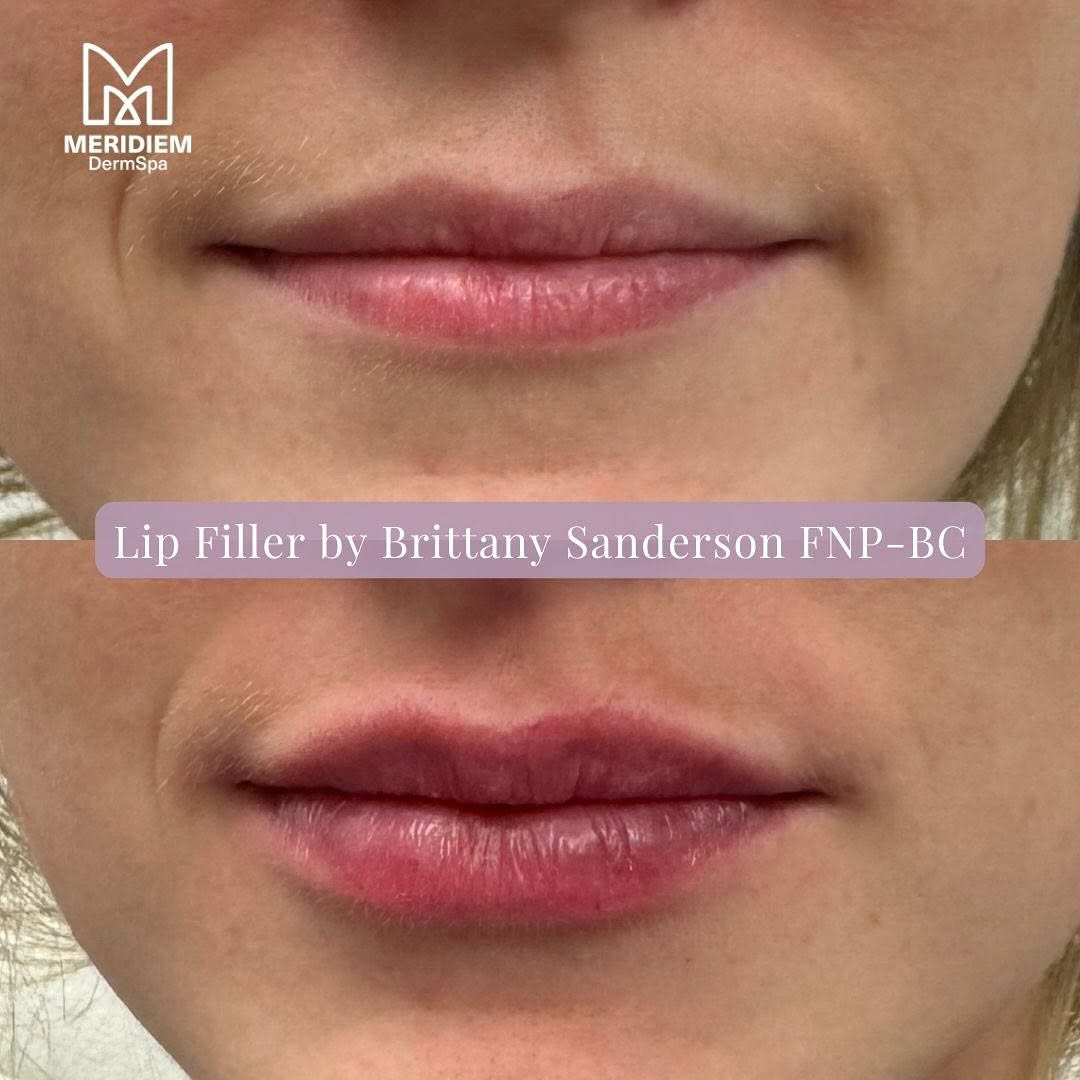 Instagram post by Dr. Brian L. Johnson: 💋 Tailor your lip volume and shape for a beautifully balanced look! Our expert injectors ensure natural-looking results that complement you…