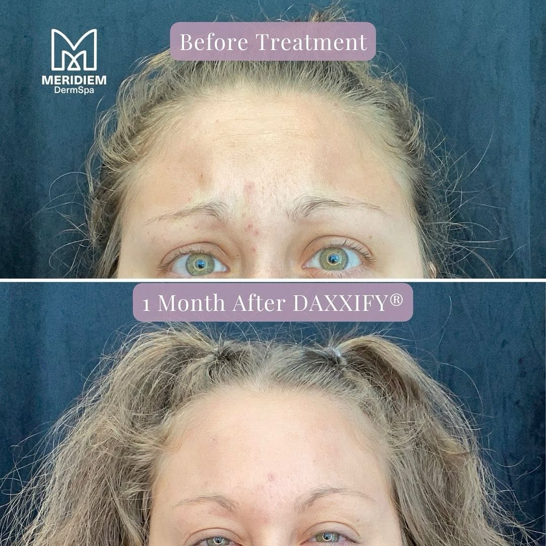 Instagram post by Dr. Brian L. Johnson: Experience the latest in wrinkle reduction with Daxxify! 💉 This neuromodulator offers longer-lasting results, smoothing lines while also pr…