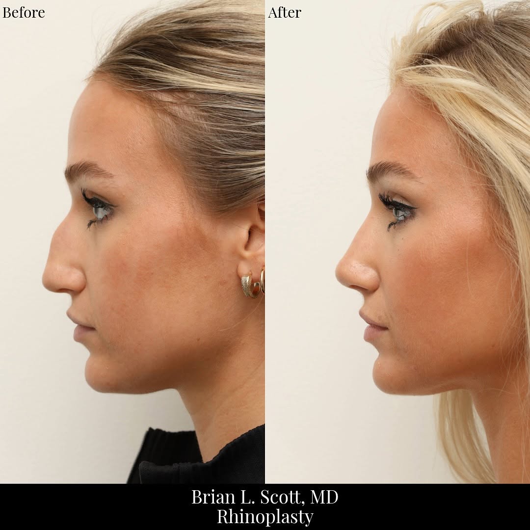 Instagram post by Dr. Brian L. Scott: This gorgeous patient wanted to address a large bump and a droopy nasal tip. She is now 2 months out from a rhinoplasty and loving that her …