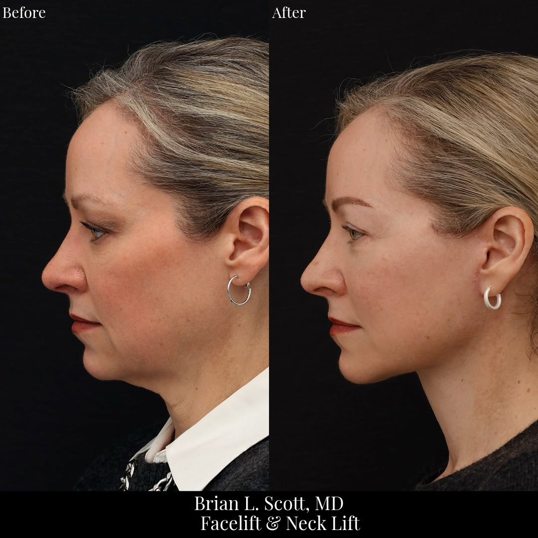 Instagram post by Dr. Brian L. Scott: This patient in her 50s wanted to address heaviness to her neck, jowls, lower face, and upper eyes. She is now 5 months out from a deep plan…