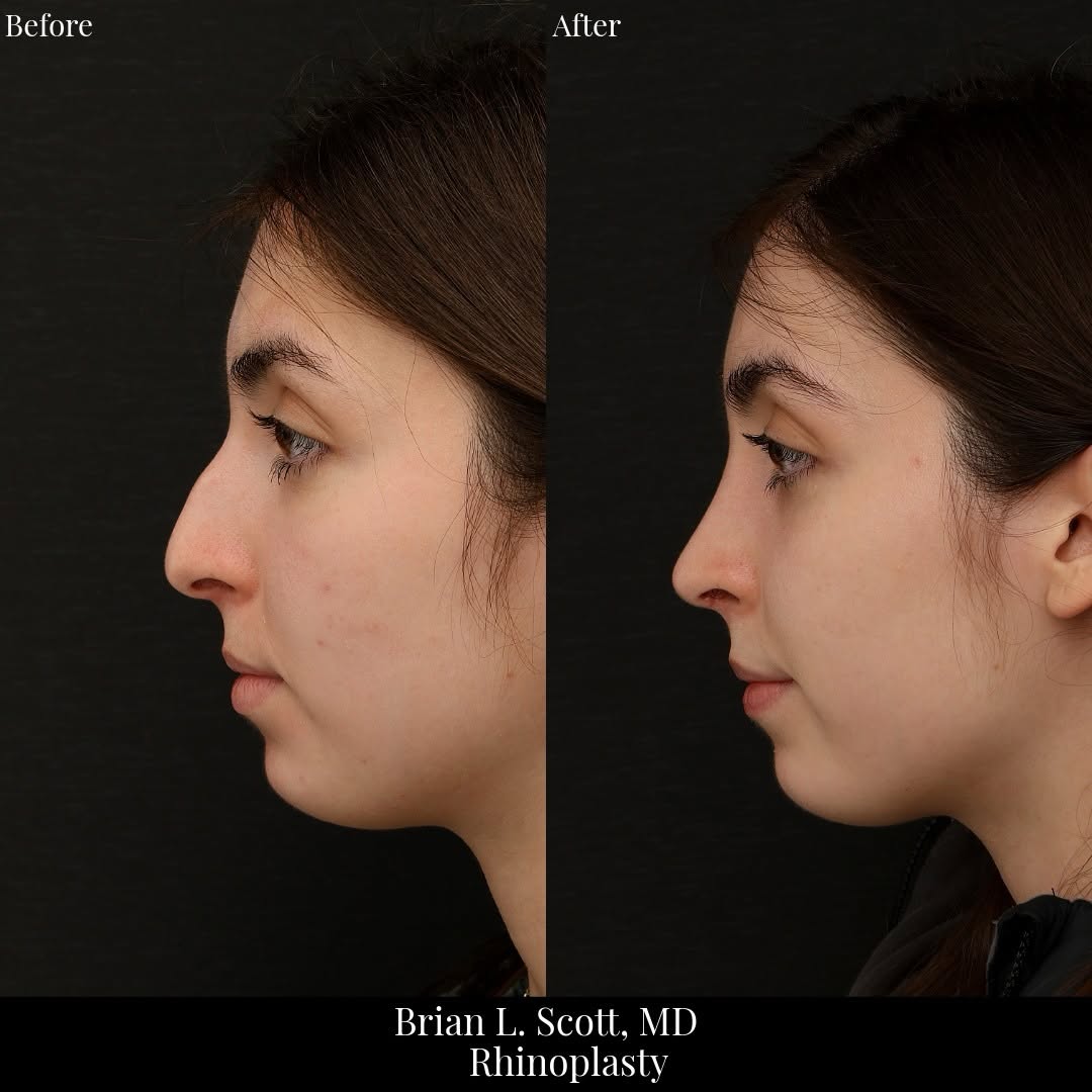 Instagram post by Dr. Brian L. Scott: This patient in her 20s wanted to refine her nose. She most bothered by her side view. Her man goal was to lower her bump and create a more …
