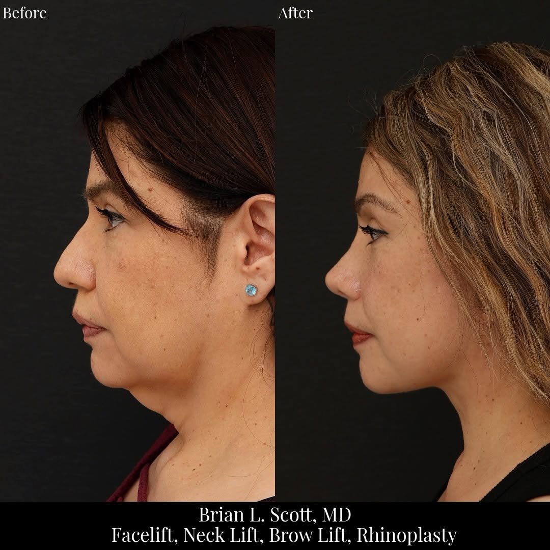 Instagram post by Dr. Brian L. Scott: Some patients want subtle changes and others want dramatic transformations. This patient in her 50s wanted the latter. She is now over 1 yea…