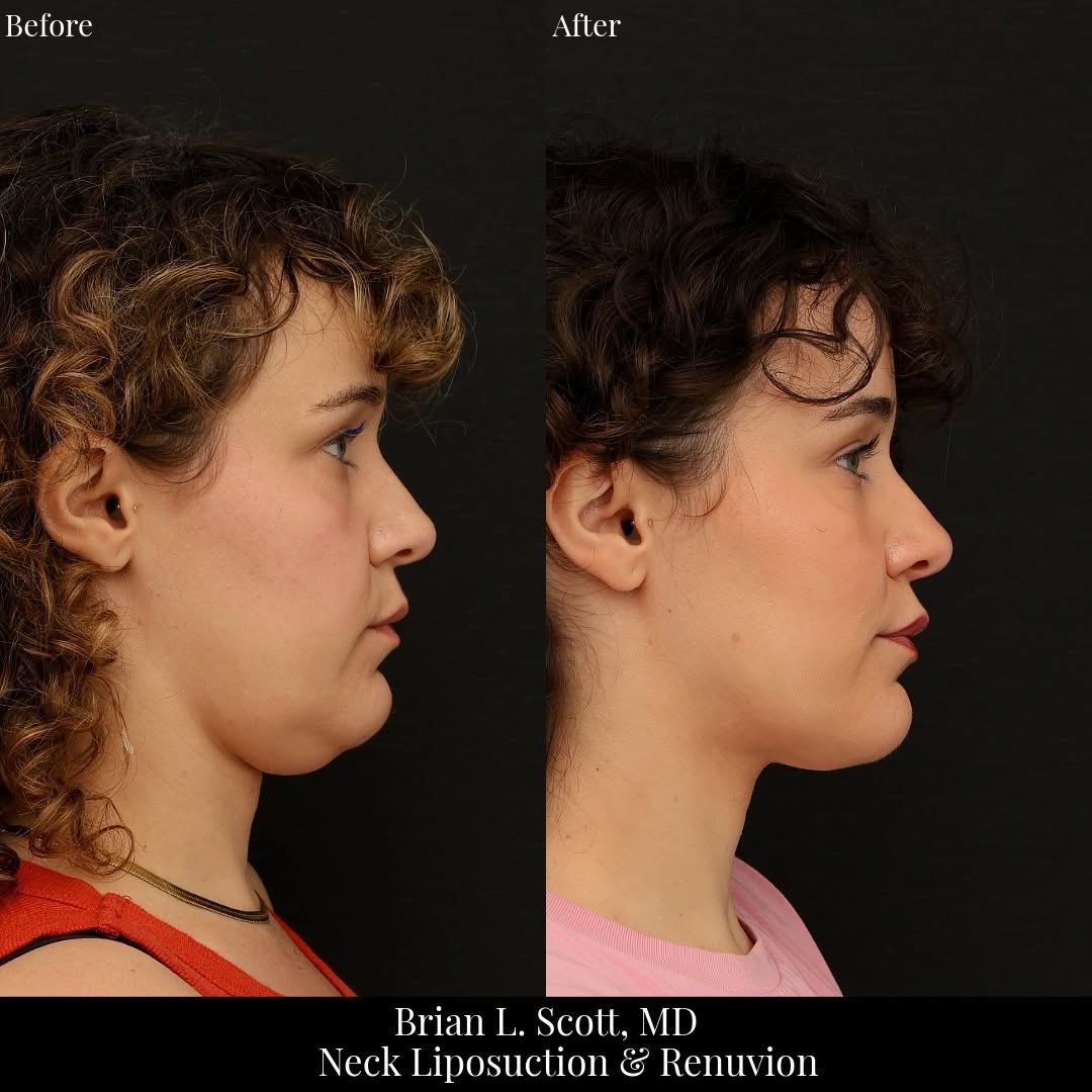 Instagram post by Dr. Brian L. Scott: This patient in her 30s disliked the fullness under her chin and jawline, despite being at a very healthy weight. As her 30s progressed she …